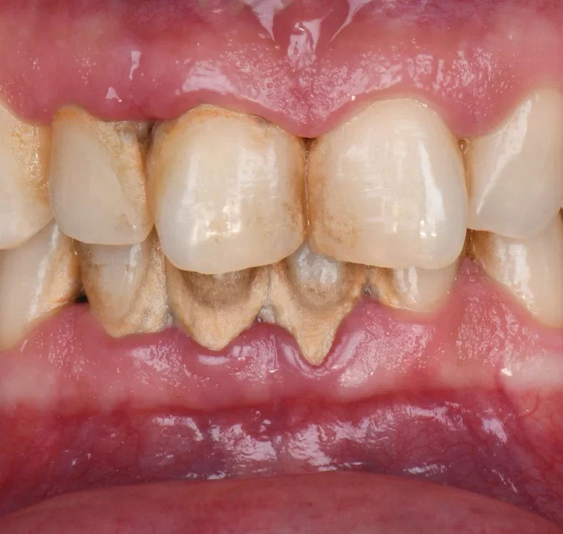 Gum Problems