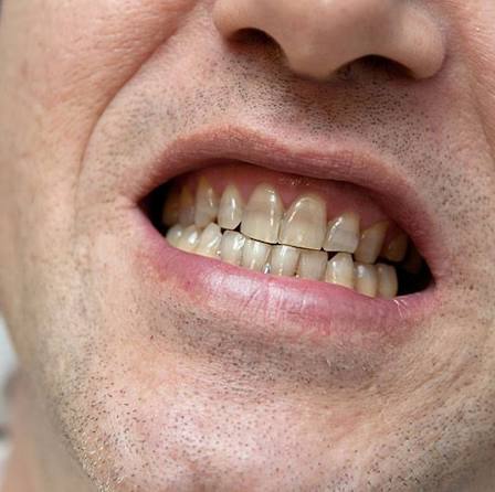 Stained Teeth